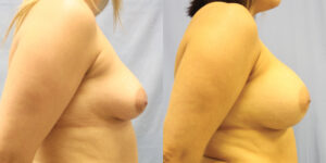 Patient 43c Breast Augmentation Before and After