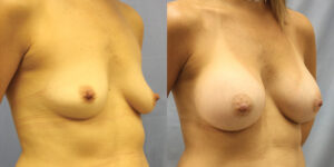 Patient 44b Breast Augmentation Before and After
