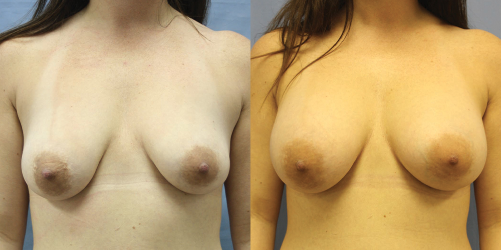 Patient 45a Breast Augmentation Before and After