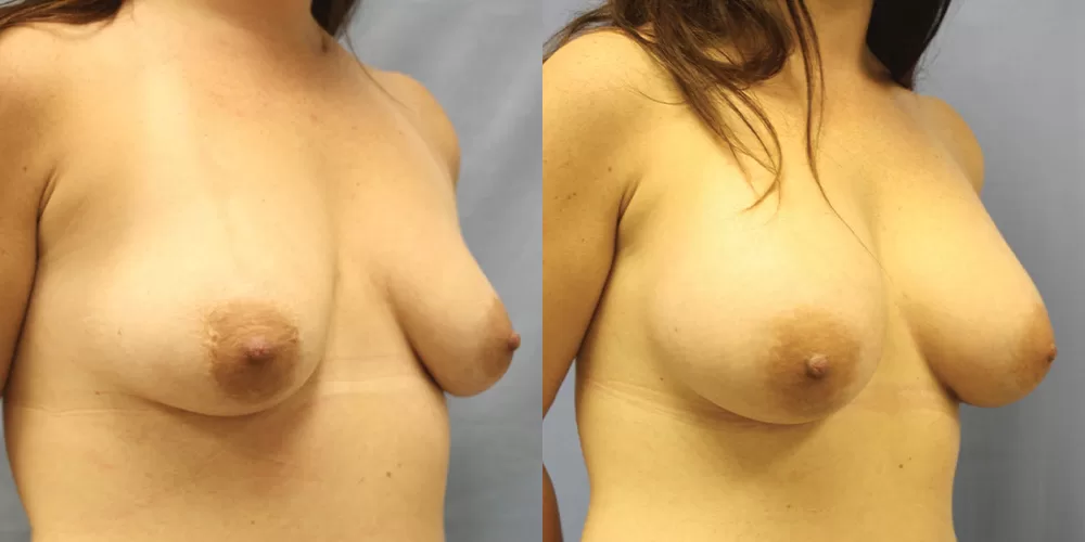 Patient 45b breast augmentation before and after