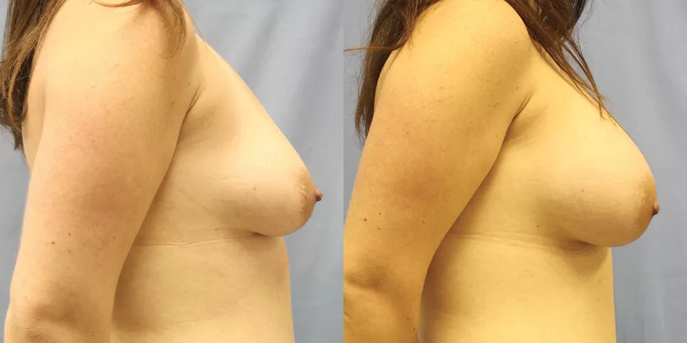 Patient 45c breast augmentation before and after