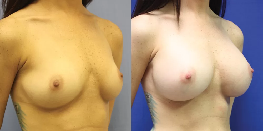 Patient 46b breast augmentation before and after
