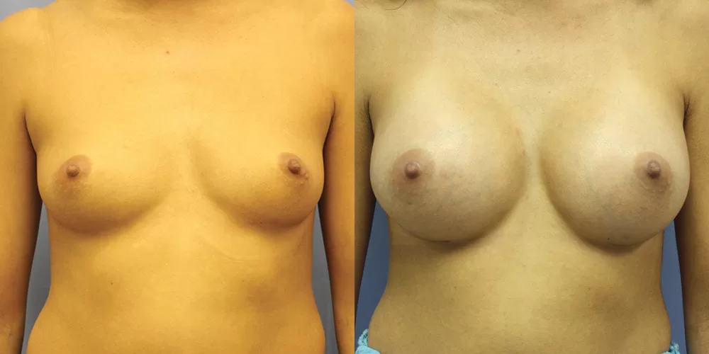 Patient 47a breast augmentation before and after