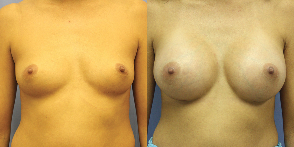 Patient 47a Breast Augmentation Before and After