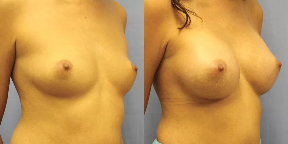 Patient 47b breast augmentation before and after