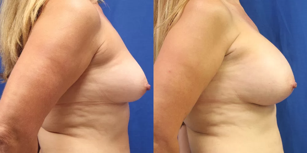 Patient 48c breast augmentation before and after