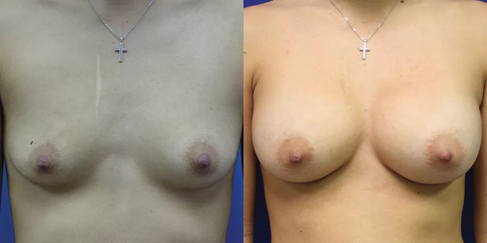 Patient 49a breast augmentation before and after