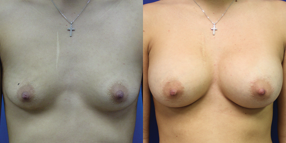 Patient 49a Breast Augmentation Before and After