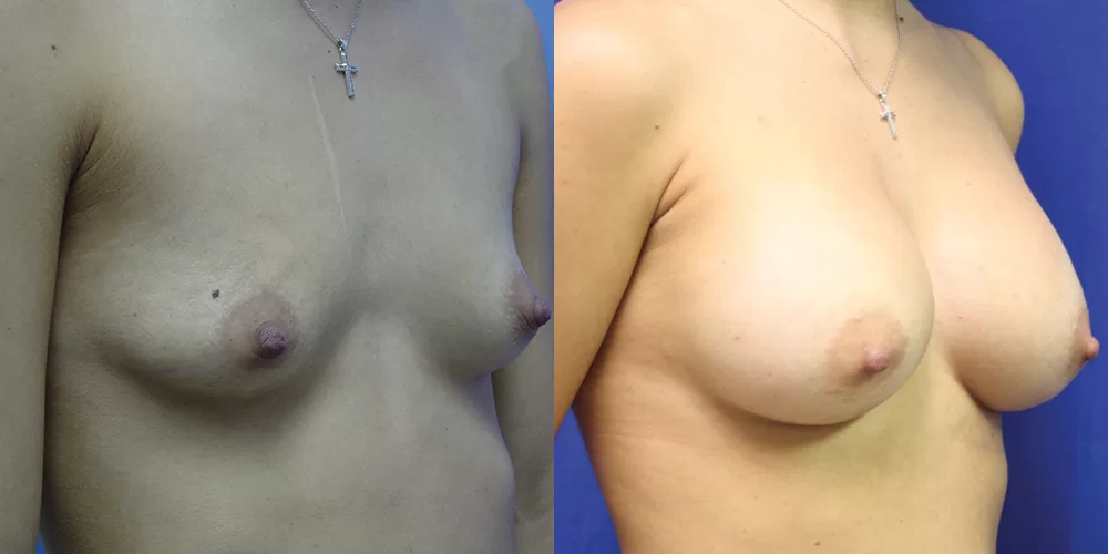 Patient 49b breast augmentation before and after