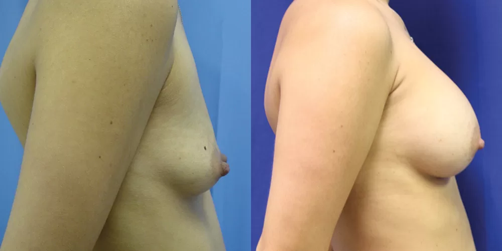 Patient 49c breast augmentation before and after