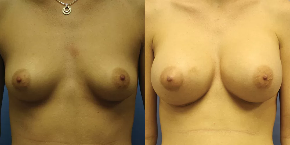 Patient 50a breast augmentation before and after