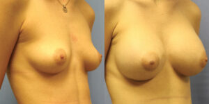 Patient 50b Breast Augmentation Before and After