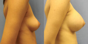 Patient 50c Breast Augmentation Before and After