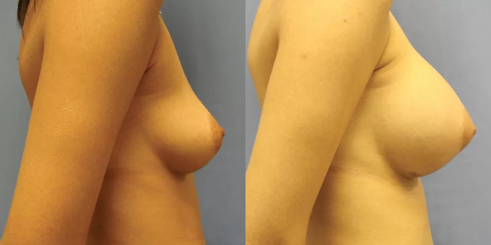 Patient 50c breast augmentation before and after