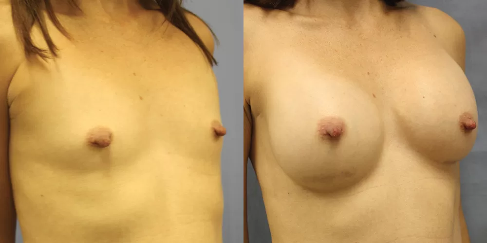 Patient 51b breast augmentation before and after