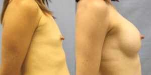 Patient 51c Breast Augmentation Before and After