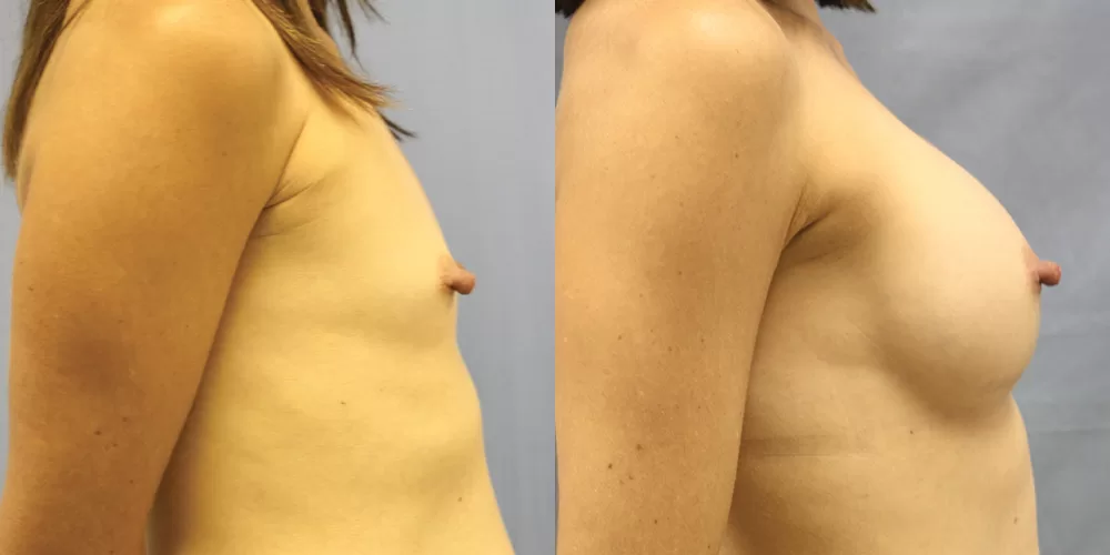 Patient 51c breast augmentation before and after