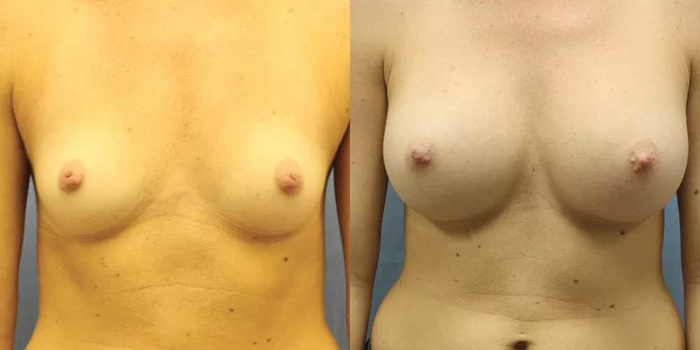 Patient 52a breast augmentation before and after