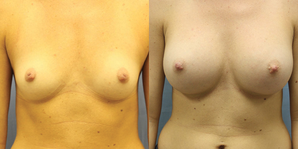 Patient 52a Breast Augmentation Before and After