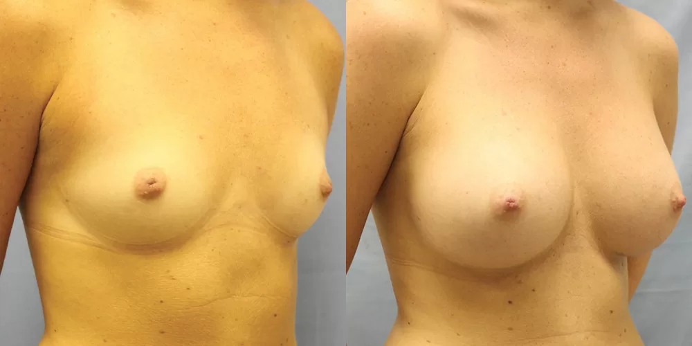 Patient 52b breast augmentation before and after