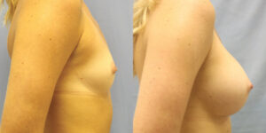 Patient 52c Breast Augmentation Before and After