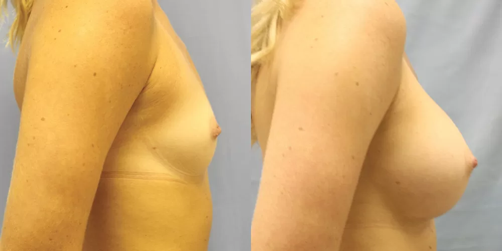 Patient 52c breast augmentation before and after