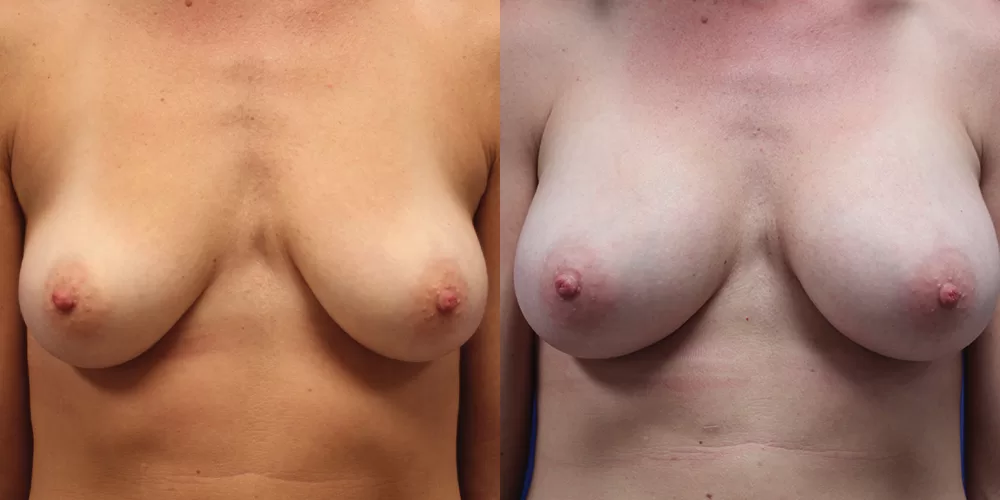 Patient 53a breast augmentation before and after