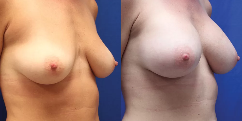 Patient 53b breast augmentation before and after
