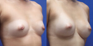 Patient 54b Breast Augmentation Before and After