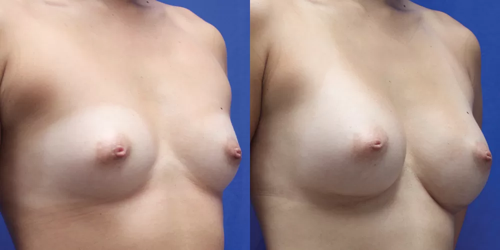 Moratis plastic surgery breast augmentation patient 54b