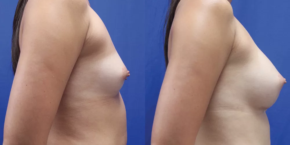 Patient 54c breast augmentation before and after