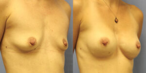 Patient 55b Breast Augmentation Before and After