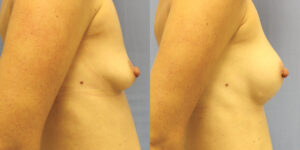 Patient 55c Breast Augmentation Before and After