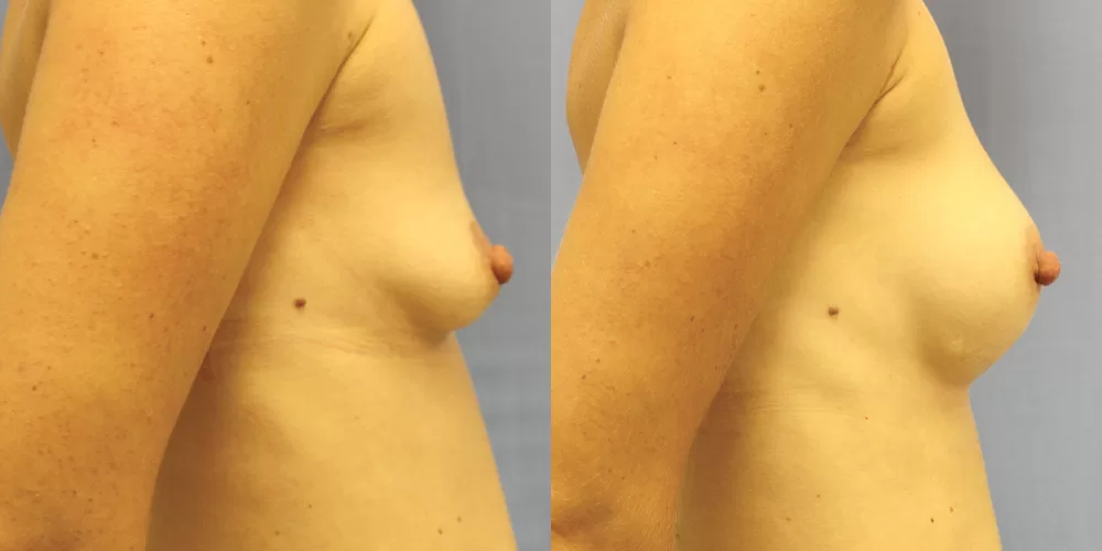 Patient 55c breast augmentation before and after