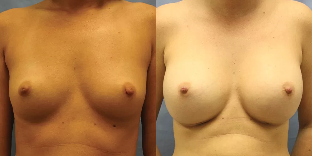Patient 56a breast augmentation before and after