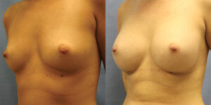 Patient 56b Breast Augmentation Before and After