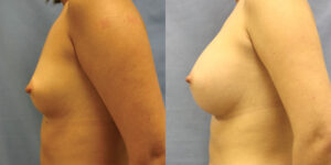Patient 56c Breast Augmentation Before and After