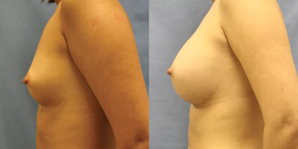 Patient 56c breast augmentation before and after