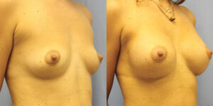 Patient 57b Breast Augmentation Before and After