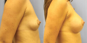 Patient 57c Breast Augmentation Before and After