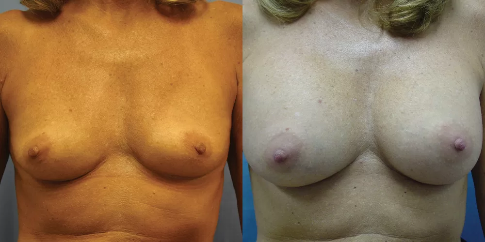 Patient 58a breast augmentation before and after