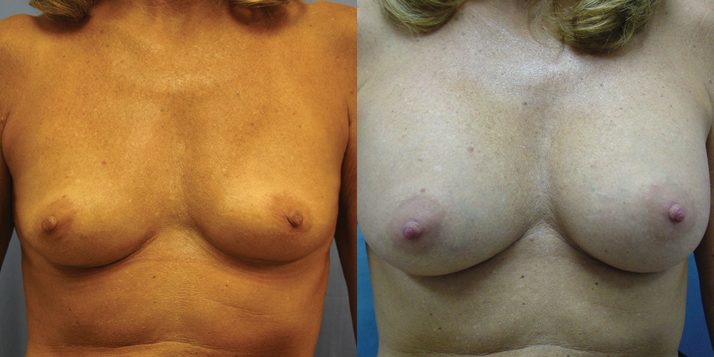 Patient 58a Breast Augmentation Before and After