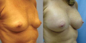 Patient 58b Breast Augmentation Before and After