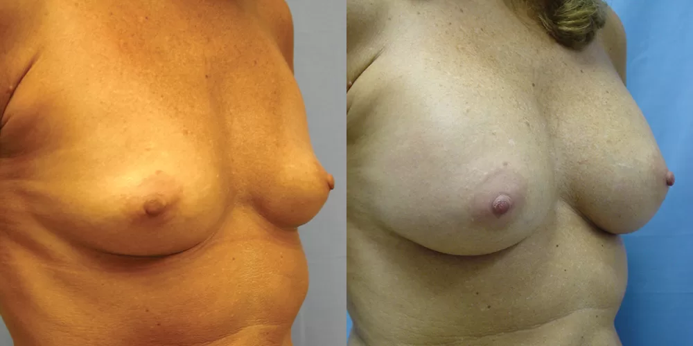 Patient 58b breast augmentation before and after