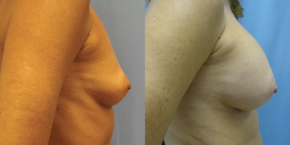 Patient 58c breast augmentation before and after