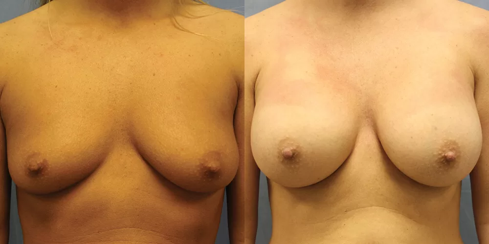 Patient 59a breast augmentation before and after