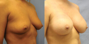 Patient 59b Breast Augmentation Before and After