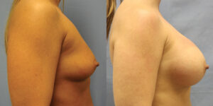 Patient 59c Breast Augmentation Before and After