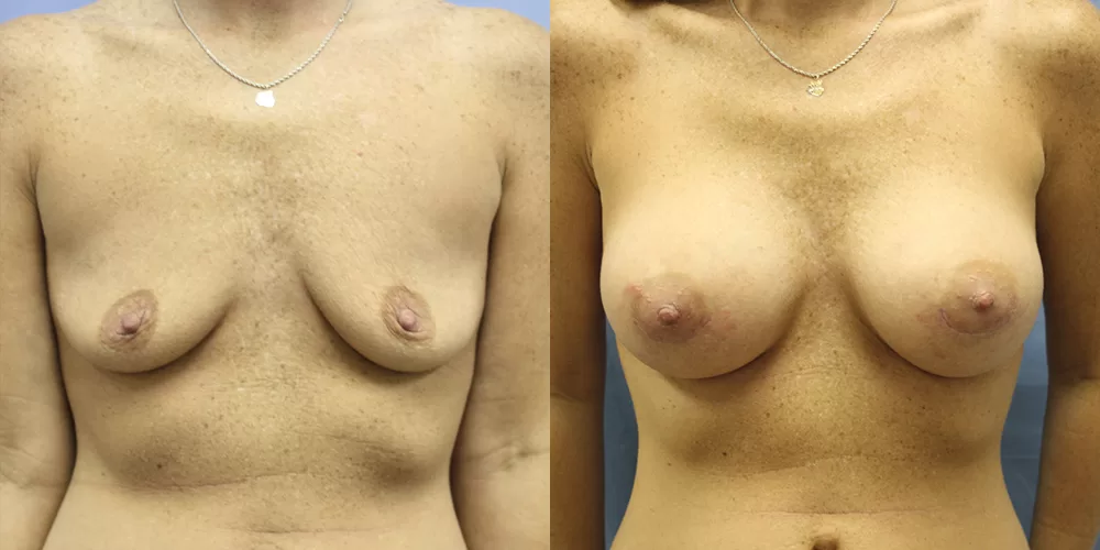 Patient 60a breast augmentation before and after