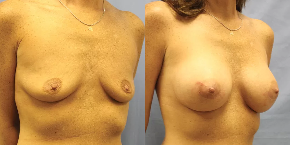 Patient 60b breast augmentation before and after